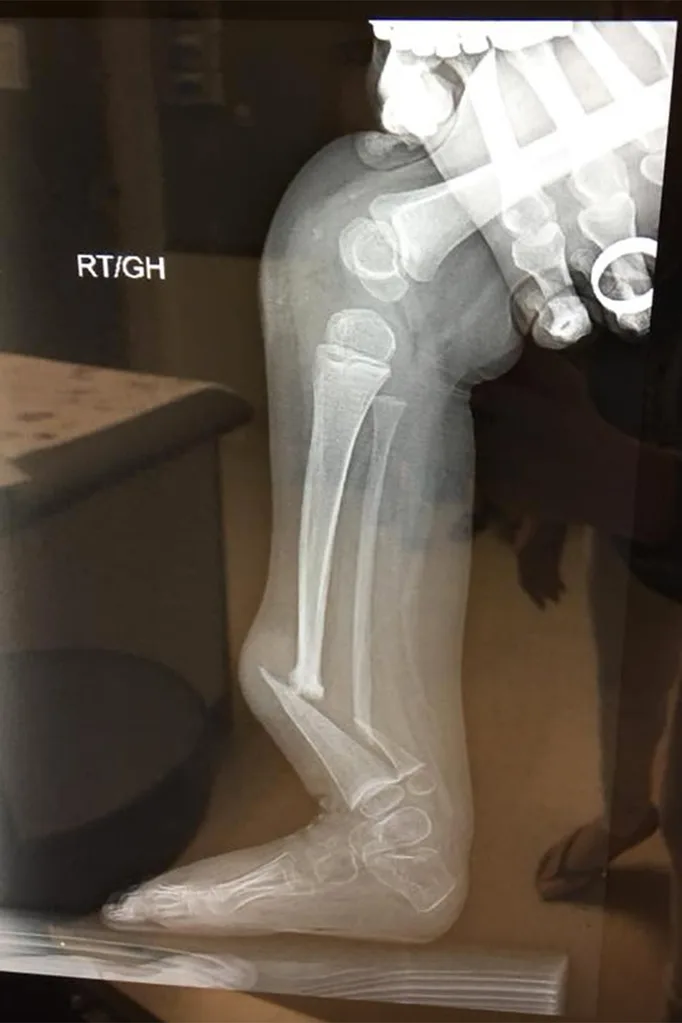 x ray