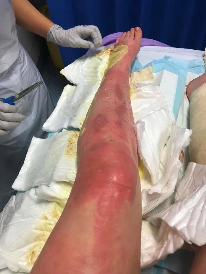 Brisbane teenager injured in bathroom explosion caused by deodorant