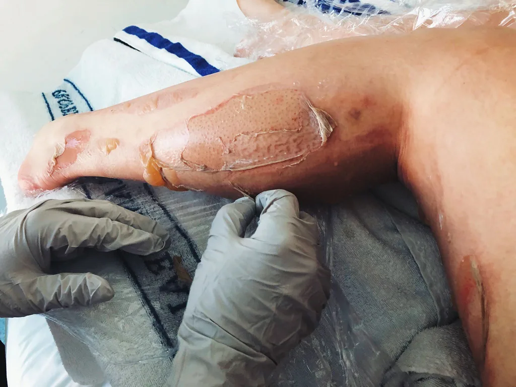 Brisbane teenager injured in bathroom explosion caused by deodorant