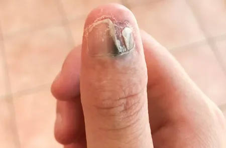 The nail started to turn black