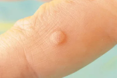 11 effective natural ways to get rid of irritating warts