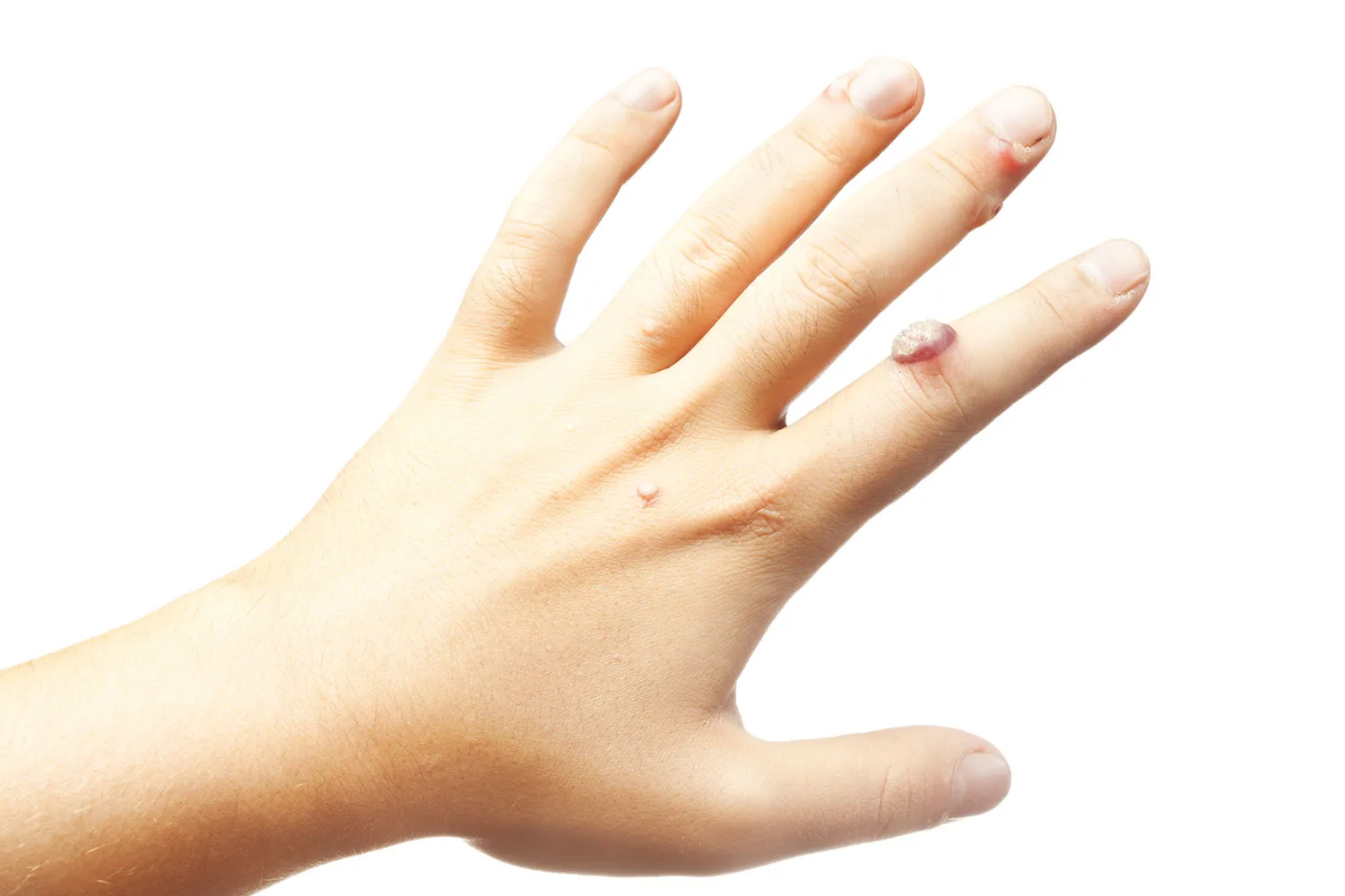 9 easy ways to get rid of warts
