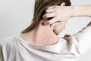 5 tips for managing eczema as the weather heats up