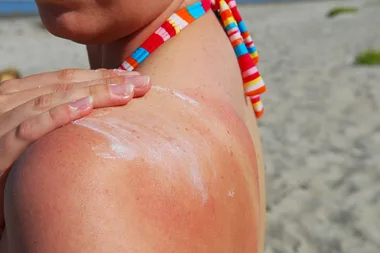 How to heal sunburn quickly