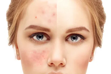 What you don’t know about breakouts and acne