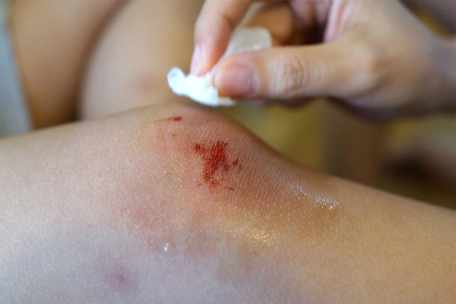 Applying cream to bruise