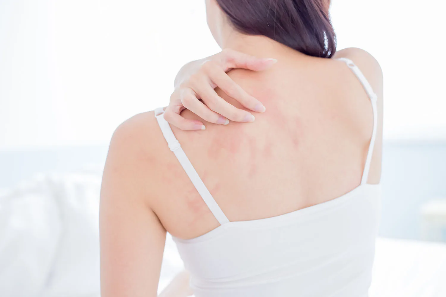 5 ways to deal with eczema in winter