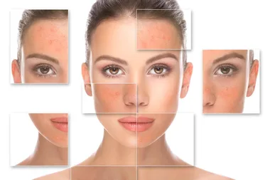 What is rosacea and how can you treat it?