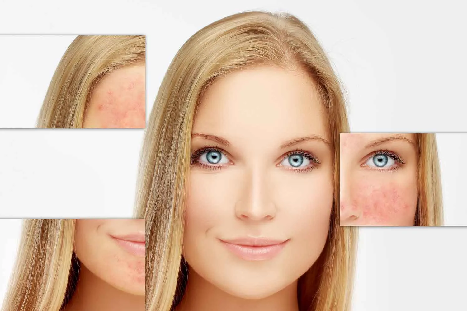 Woman with red and inflamed facial skin
