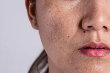 Simple and natural ways to remove age spots