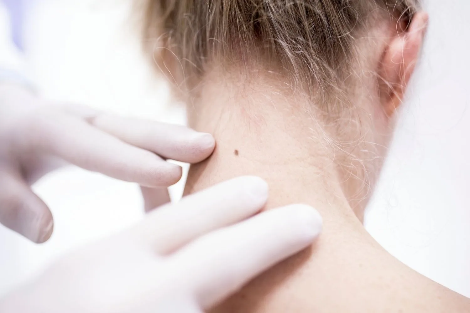 mole-removal