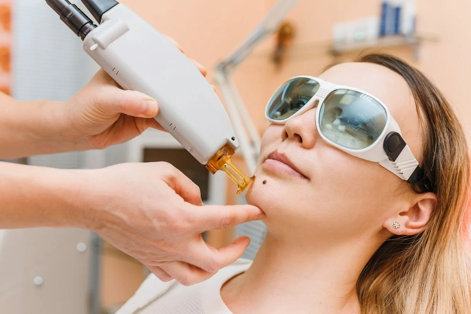laser-mole-removal