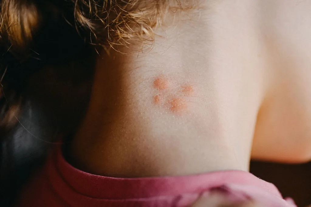 mosquito bite on neck