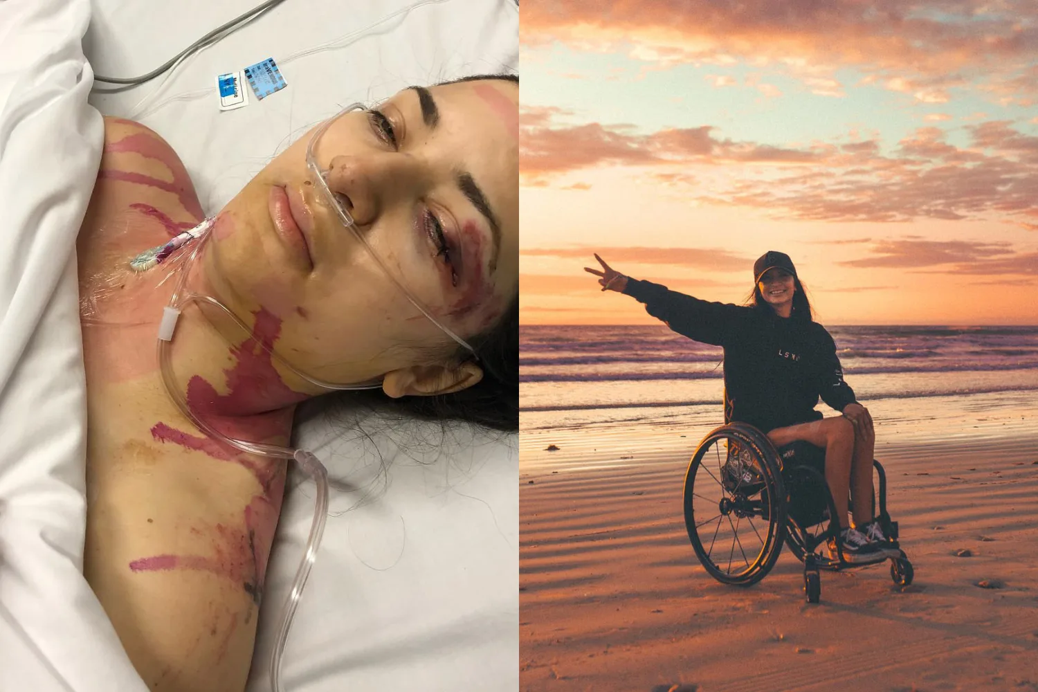 Woman pictured in hospital straight after freak accident and after photo after recovery living in a wheelchair