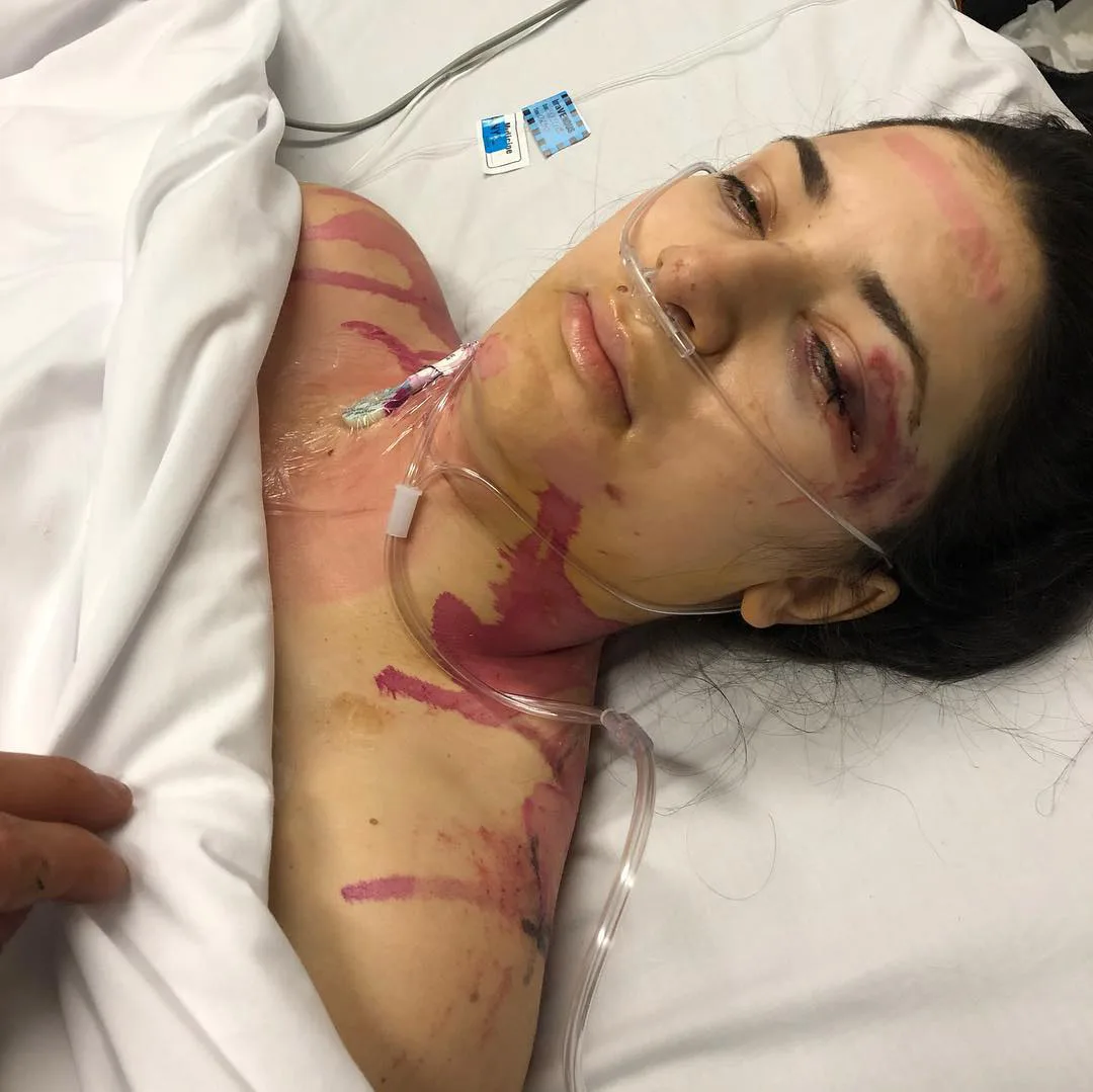 Woman recovering in hospital after freak accident while riding motocross