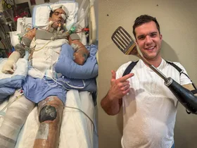 Feature image picturing man before and after his accident with a firework