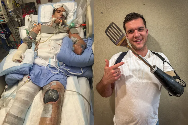 Feature image picturing man before and after his accident with a firework