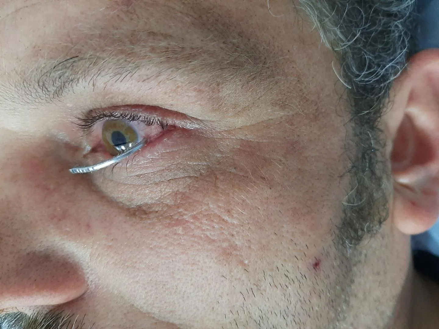 Image of man with nail hanging out of his left eye below the eyeball and above the lower lid