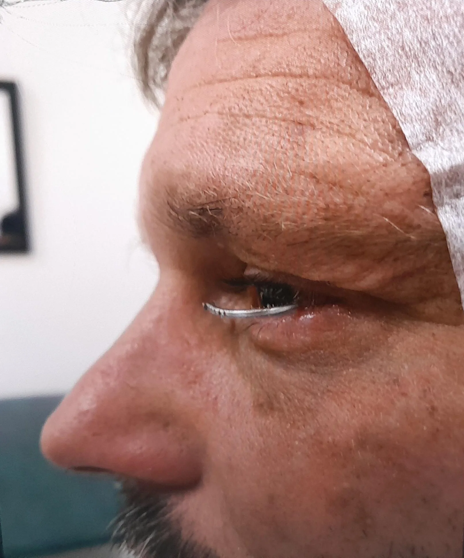 Image of side profile of man with nail sticking out from lower left eye