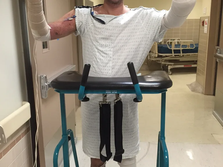 Man learning how to walk again after blowing himself up