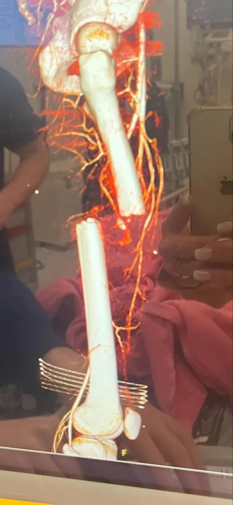 Picture of medical scan of womans snapped leg