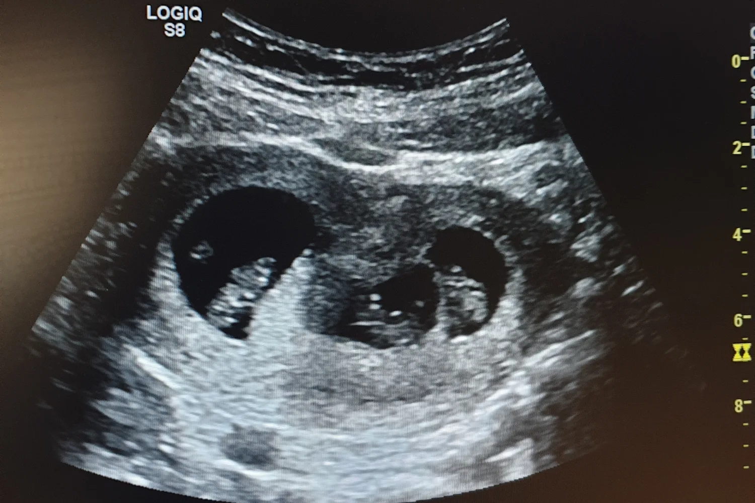 Image of pregnancy scan showing triplets