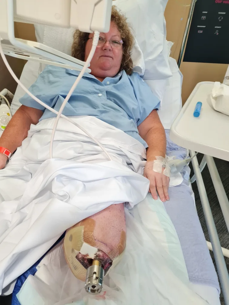 Image of woman after osseointegration surgery