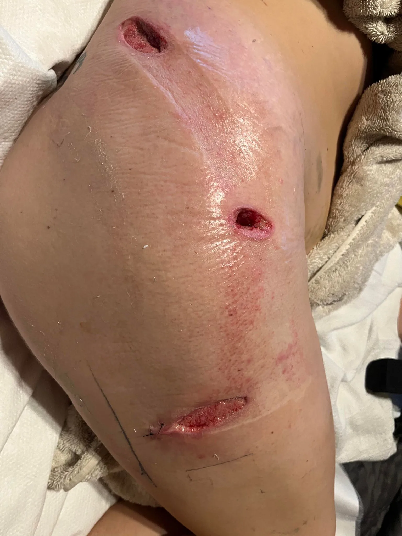A woman's upper leg with three puncture wounds which was caused by a tree branch impaling her skin