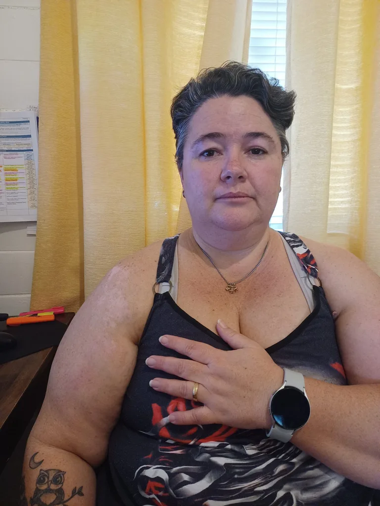 Photo of woman three months after lawnmower burn accident