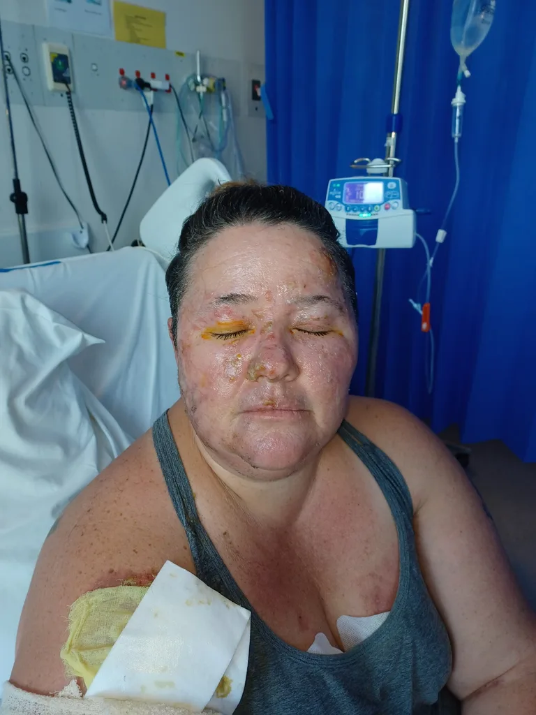 Photo of woman in hospital with facial burns