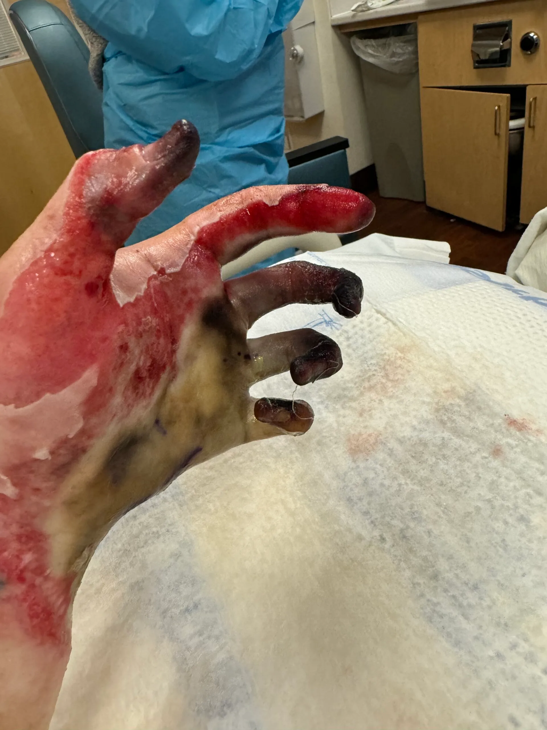 Image of hand burnt by hairdryer