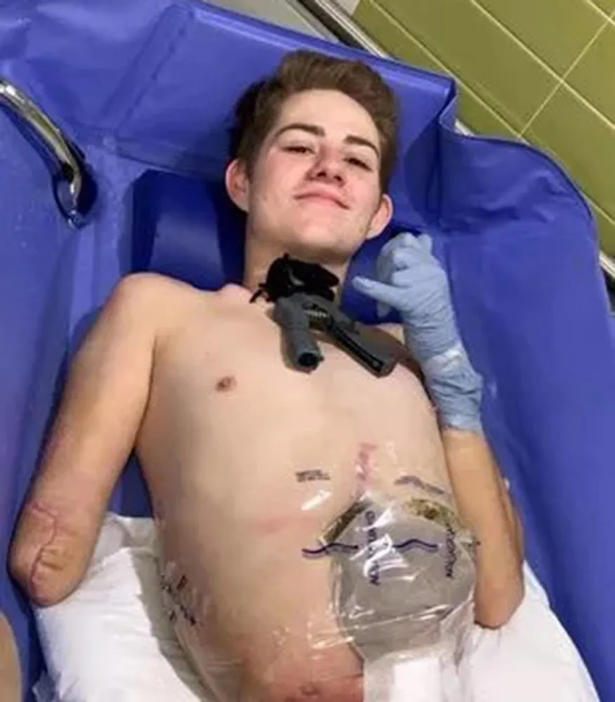 Man in hospital with no legs or arm