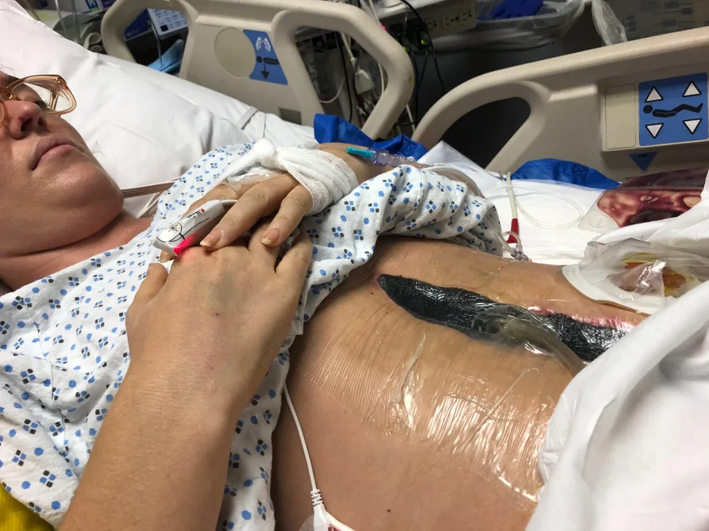 Image of woman's injuries post jetski accident