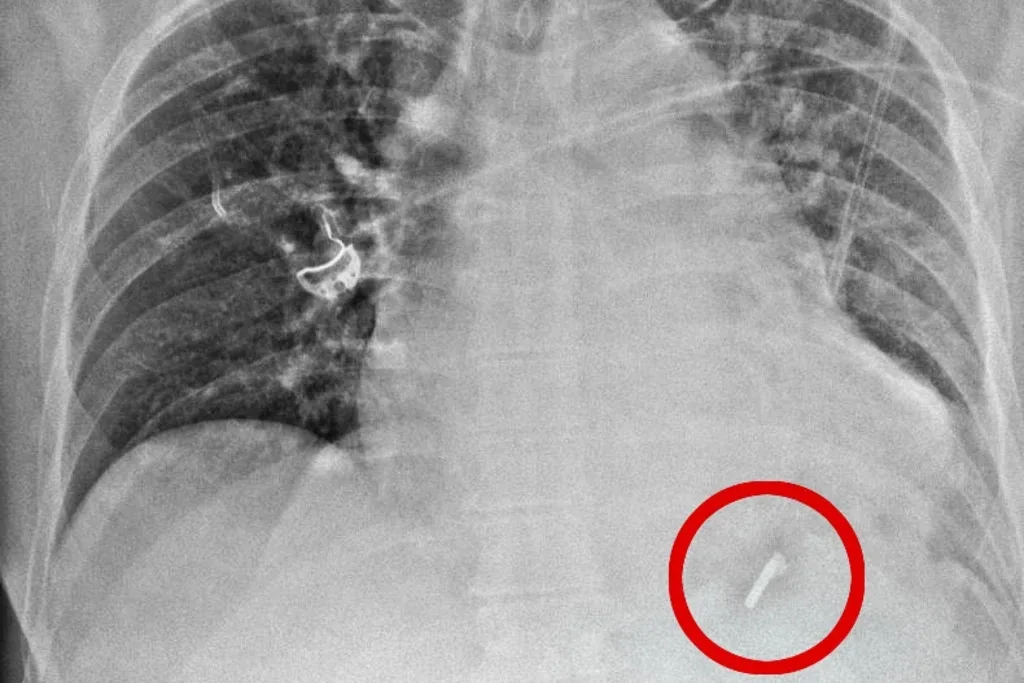 xray image of nail in heart