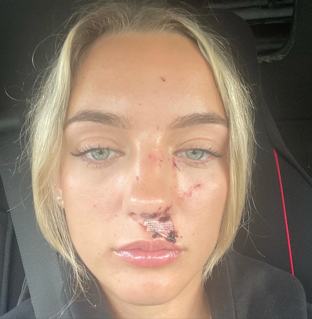Image of woman scarred after being glassed at the races