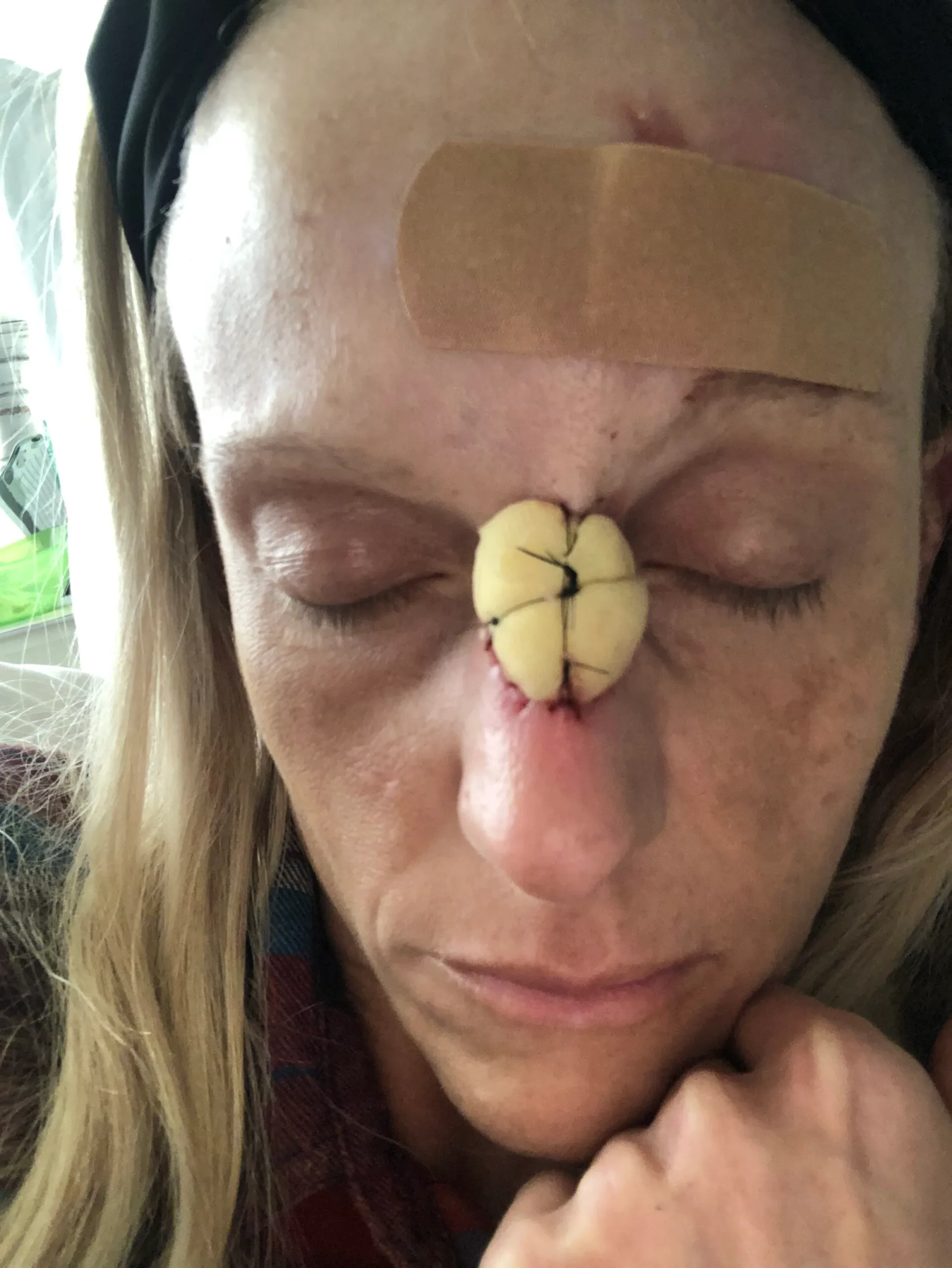 Image of womans nose wound
