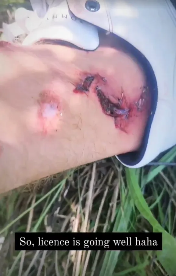 Image of mans injuries after plane crash