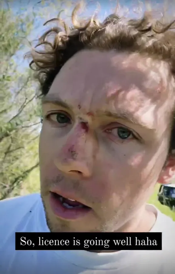 Image of mans injuries after plane crash