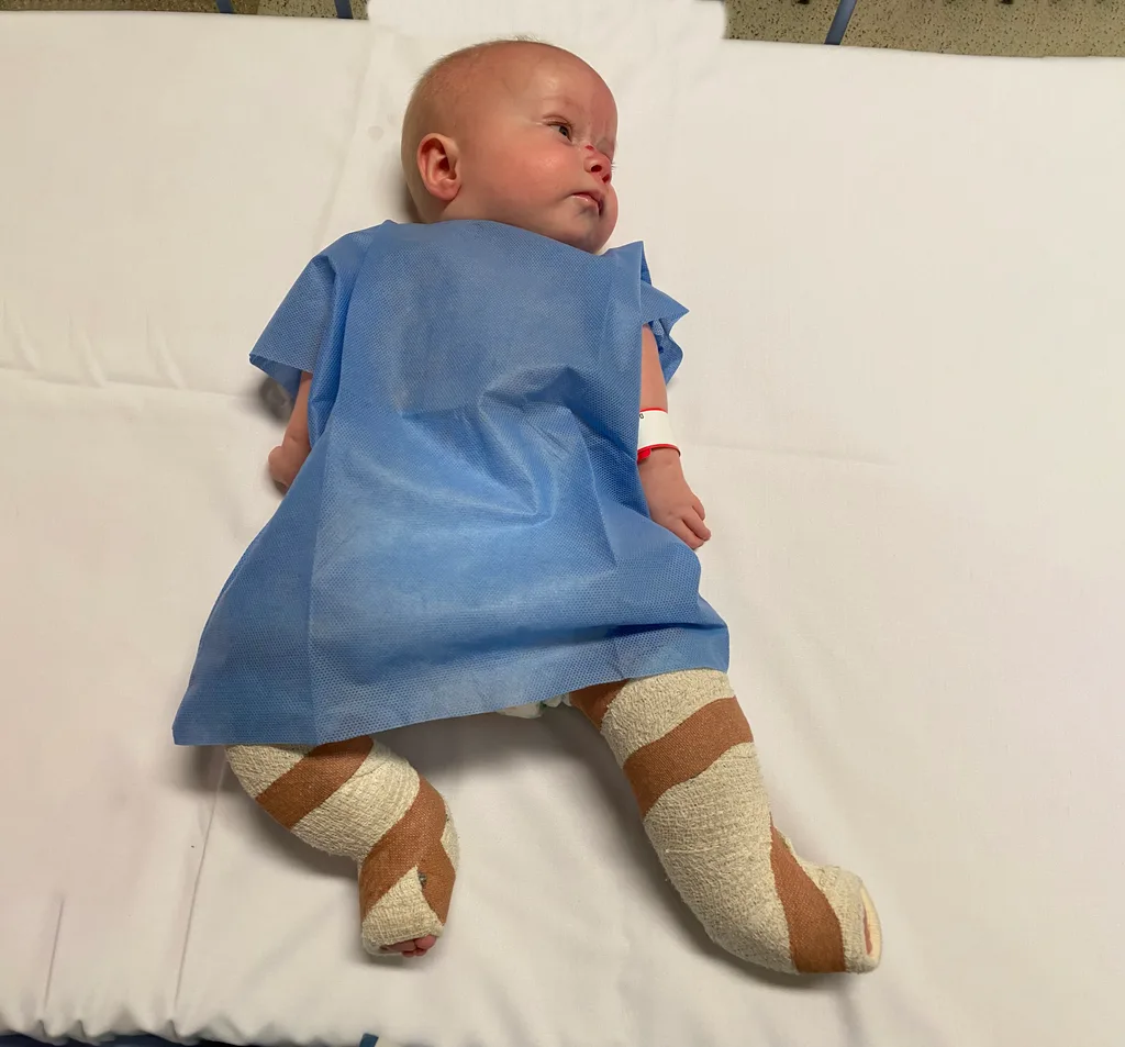 Image of young girl with castings on her legs