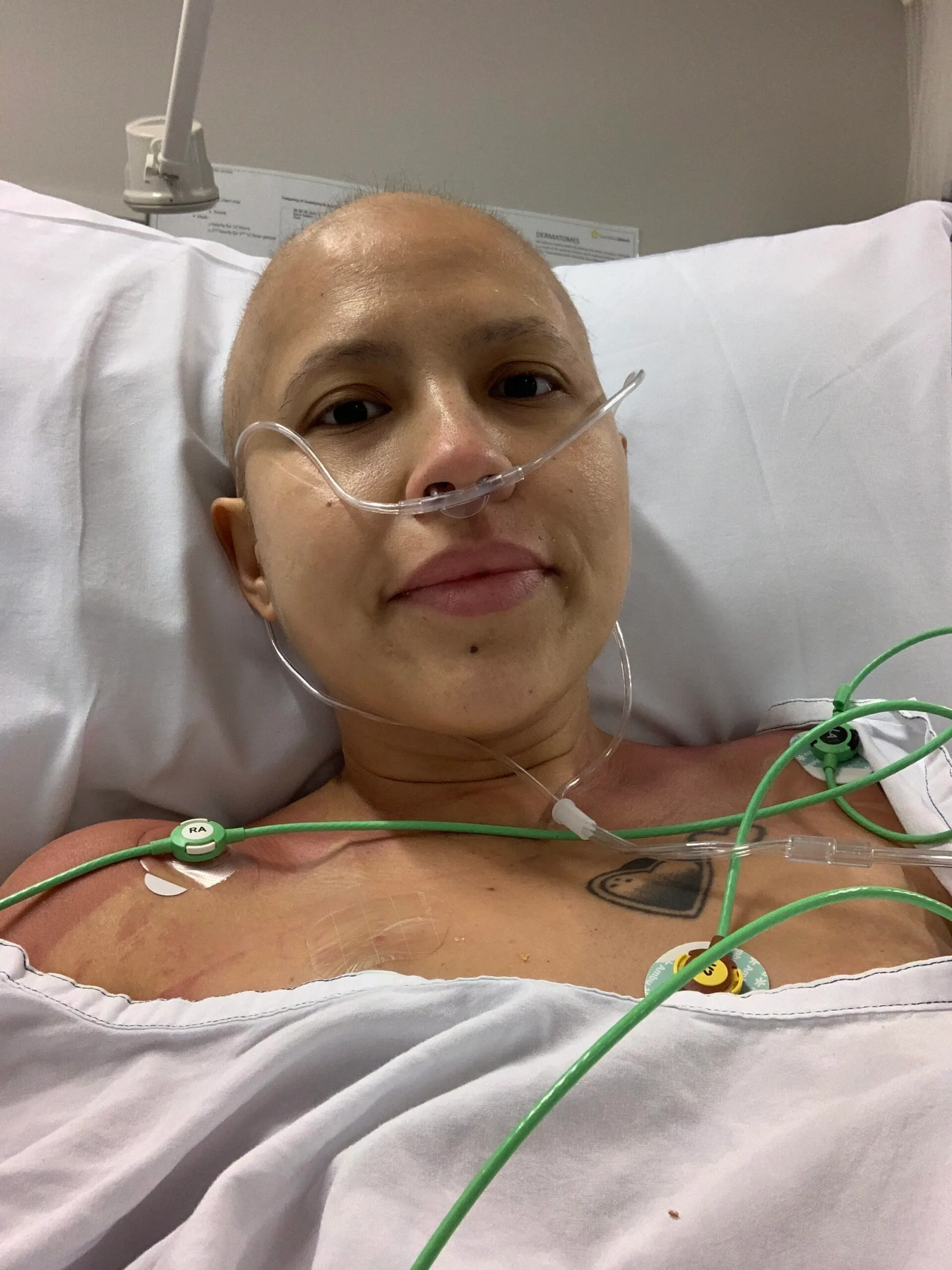 woman in hospital bed, she has no hair and is covered in wires