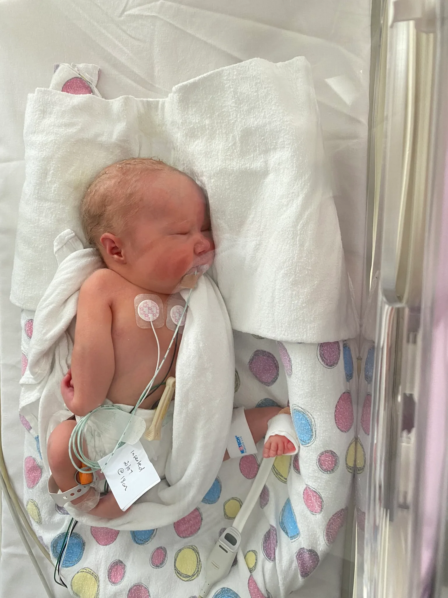 Image of young girl born with arthrogryposis