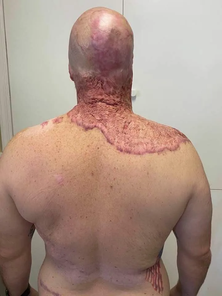 The burns from the back of John. He had painful laser scar revision treatments after being electrocuted