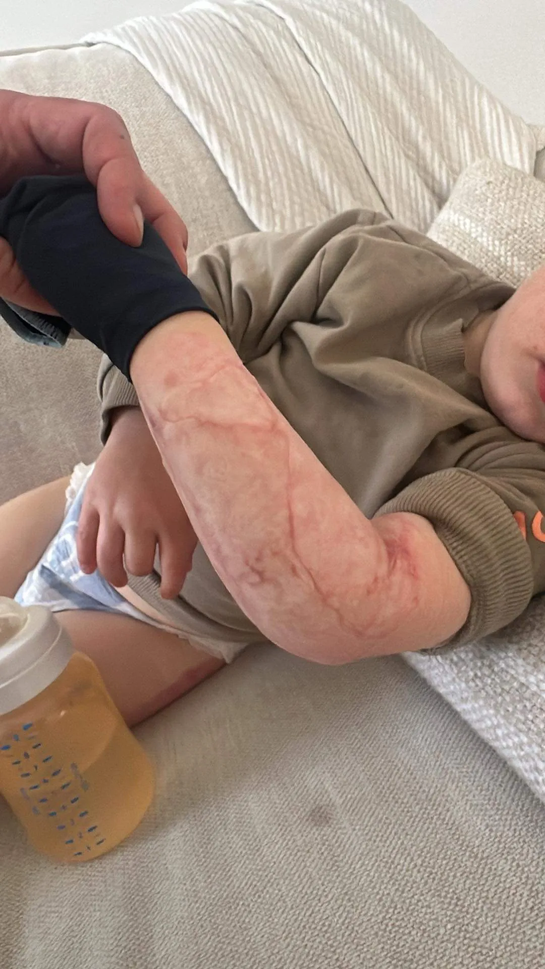 little boy with bottle and left arm in white bandage 