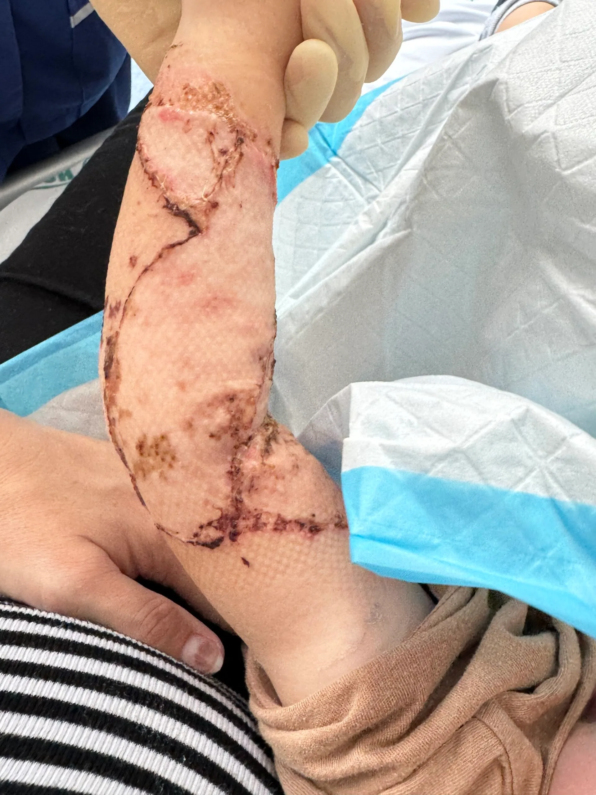 small boys arm with skin grafts