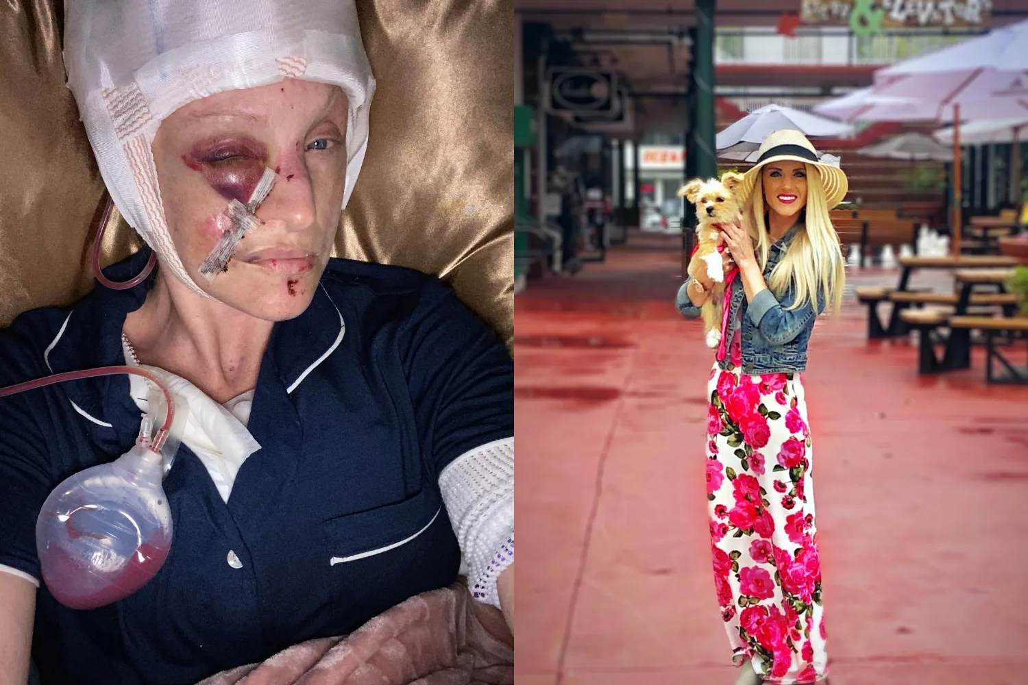 Images of woman before and after dog walk accident