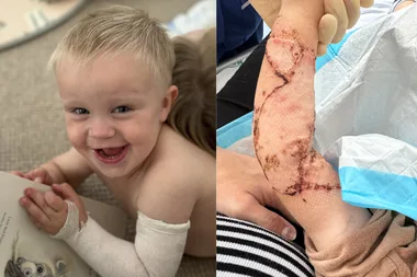 Kitchen horror: Our son’s skin was peeling off