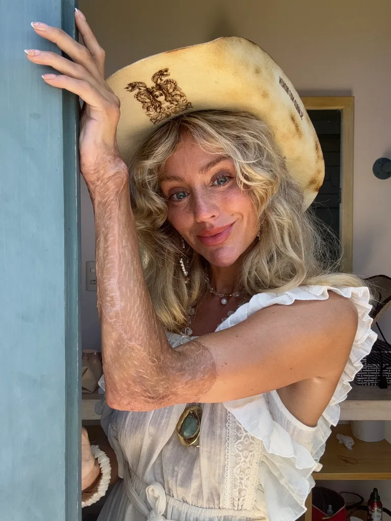 Image of woman smiling wearing cowboy hat and showing her skin grafted arm
