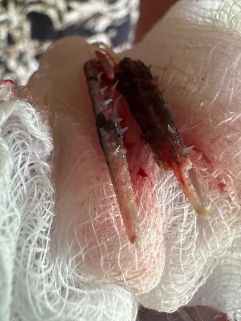 A fish beak in gauze after being removed from a man's face