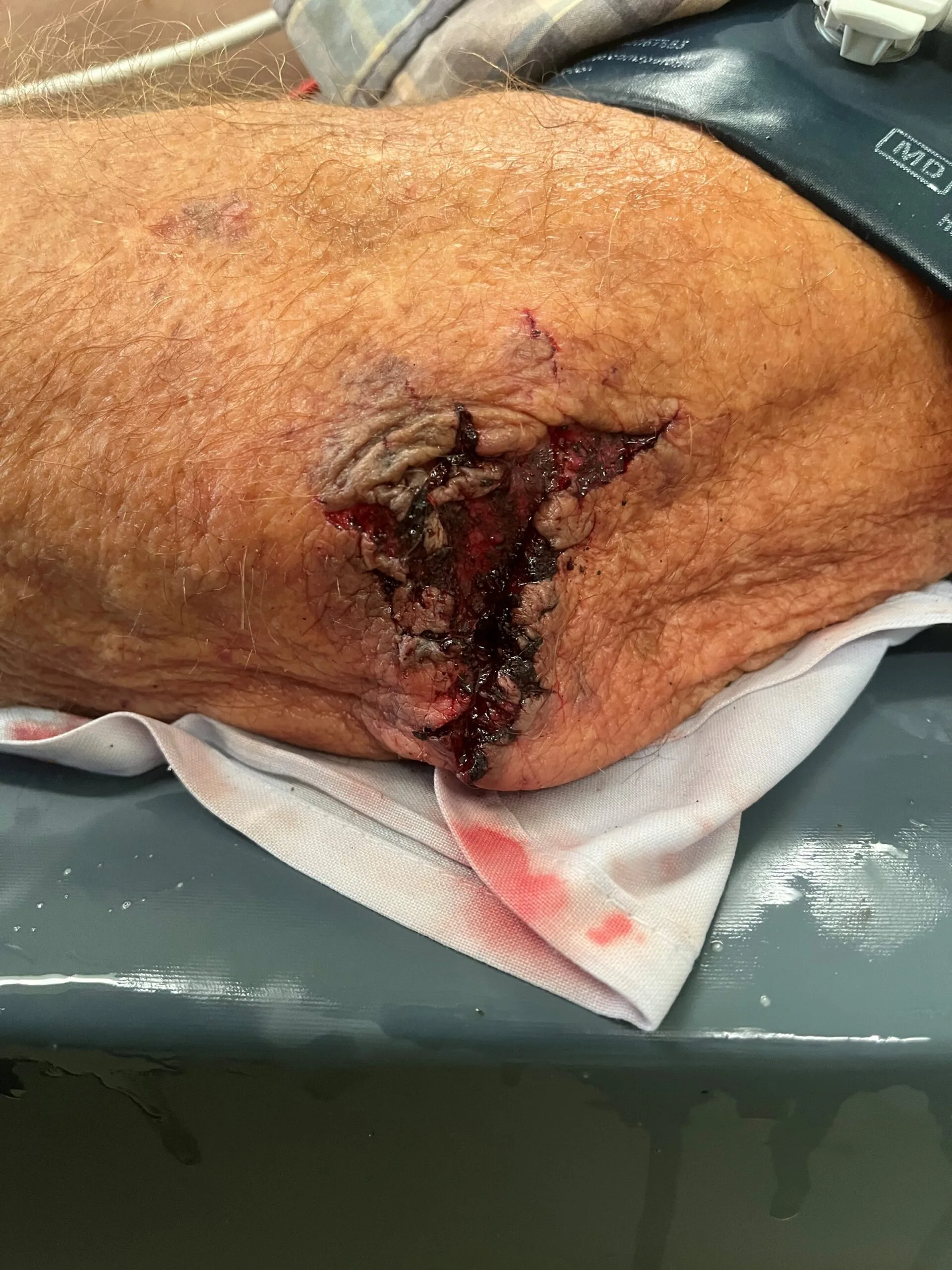 A nasty injury on a man's knee