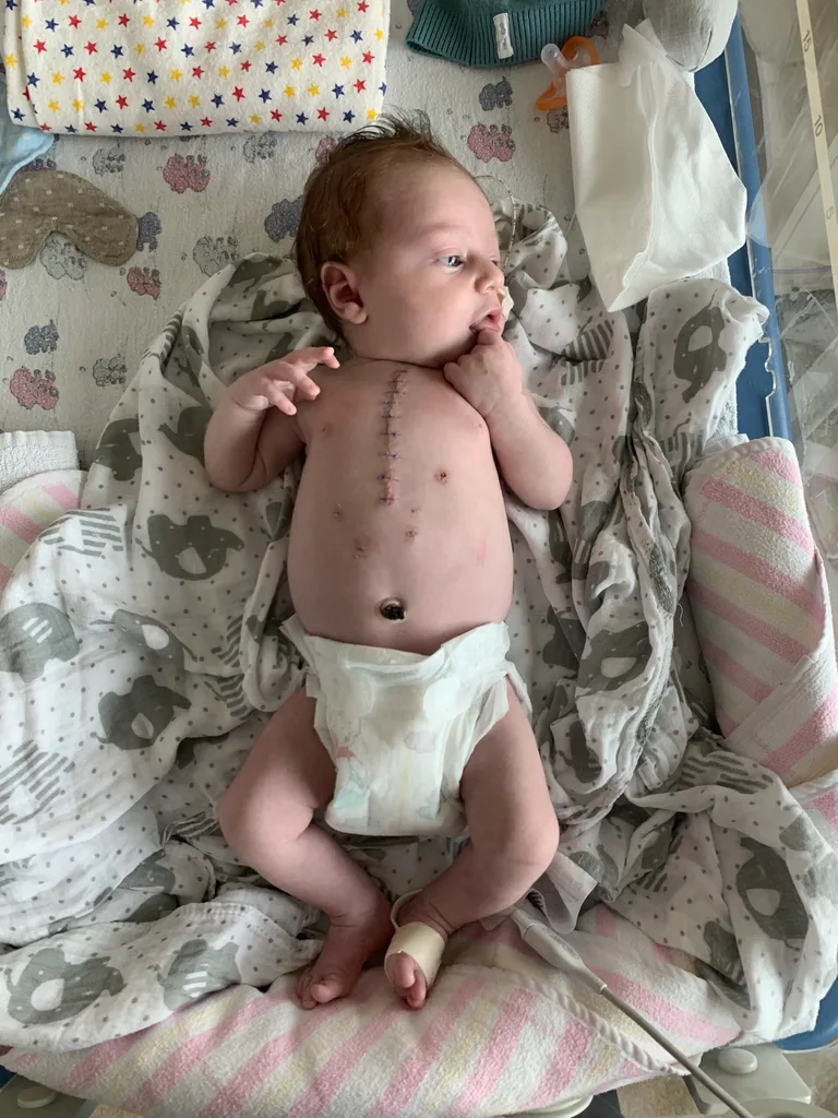 A baby wearing a nappy, he has stiches down his chest.